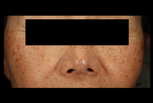 当院の症例 IPL 正面 BEFORE