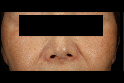 当院の症例 IPL 正面 AFTER
