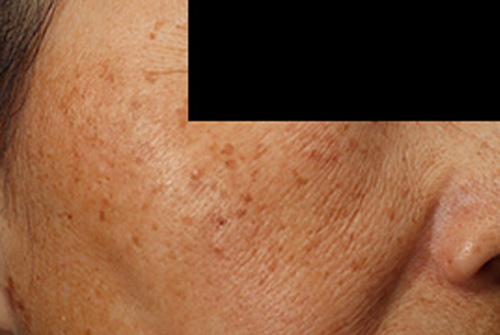 当院の症例 IPL 右側 BEFORE