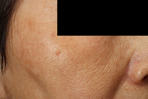 当院の症例 IPL 右側 AFTER