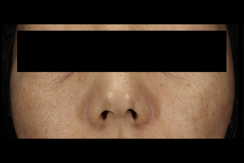 当院の症例 ピコレーザー 正面 AFTER