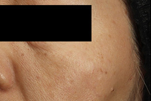 当院の症例 ピコレーザー 左側 AFTER