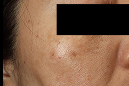 当院の症例 ピコレーザー 右側 BEFORE