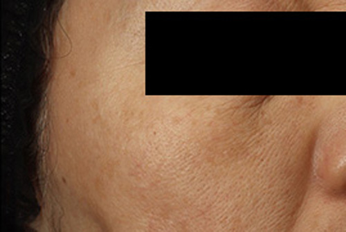 当院の症例 ピコレーザー 右側 AFTER